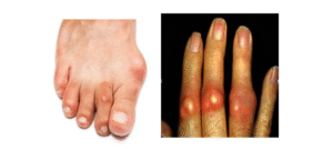 người bị gout