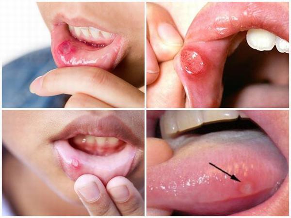 Món Nhẹ Cho Người Đang Bị Loét Miệng, Nhiệt Miệng