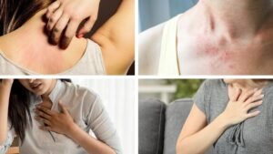 dị ứng với hạt