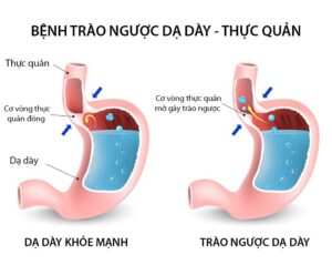 Trào ngược dạ dày