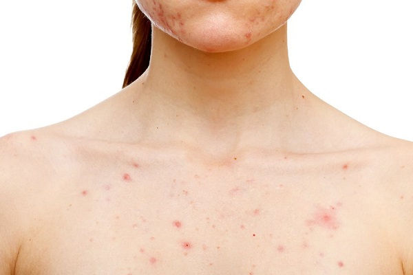 Bí Quyết Giảm Tình Trạng “Nóng Trong Người” Một Cách Tự Nhiên