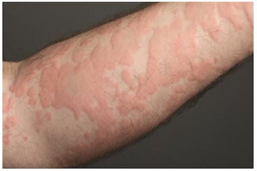 Người Dễ Nổi Mề Đay Nên Tránh Gì Trong Đồ Uống?