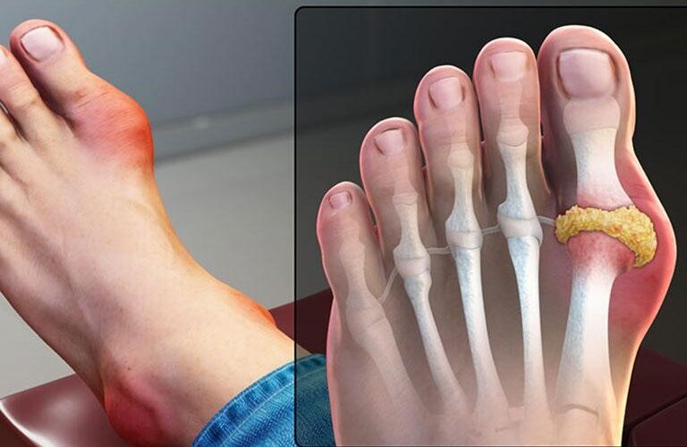 Cách Phòng Ngừa Bệnh Gout Tự Nhiên