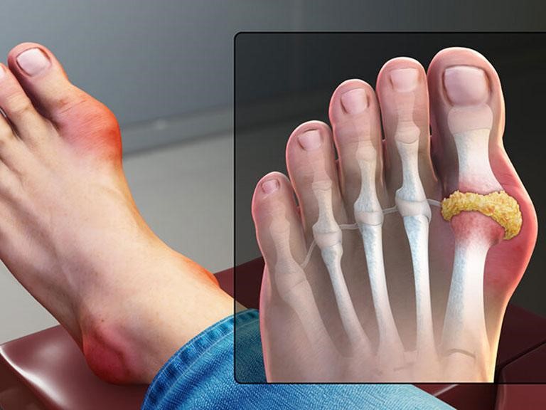 Cách Phòng Ngừa Bệnh Gout Tự Nhiên