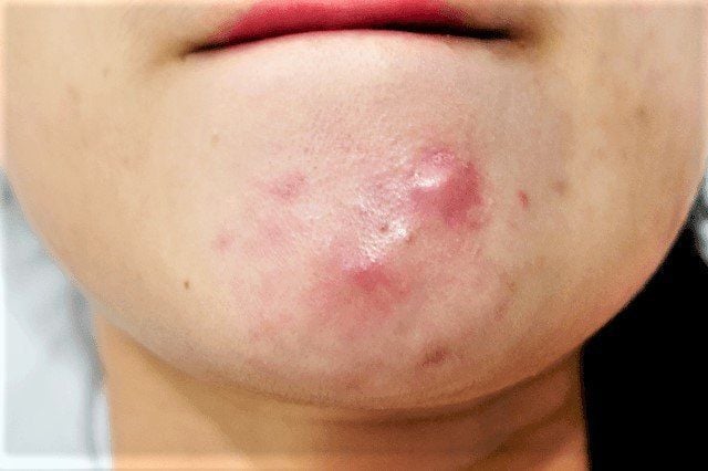 Mụn Dưới Cằm – Dấu Hiệu Nội Tiết Thay Đổi?