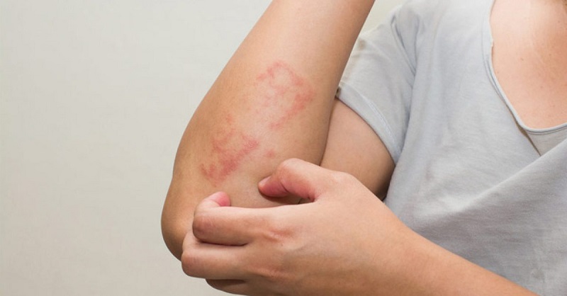 Người Hay Bị Nấm Da – Liên Quan Gì Đến Đề Kháng?