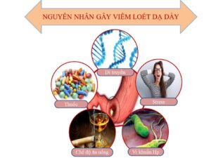 Nguyên Nhân Gây Loét Dạ Dày