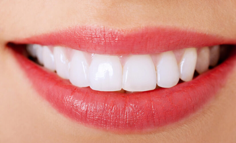 răng trắng