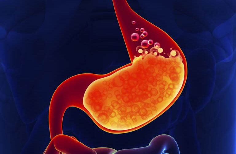 Tăng Axit Dạ Dày Vì Ăn Cay – Cách Giảm Nhanh