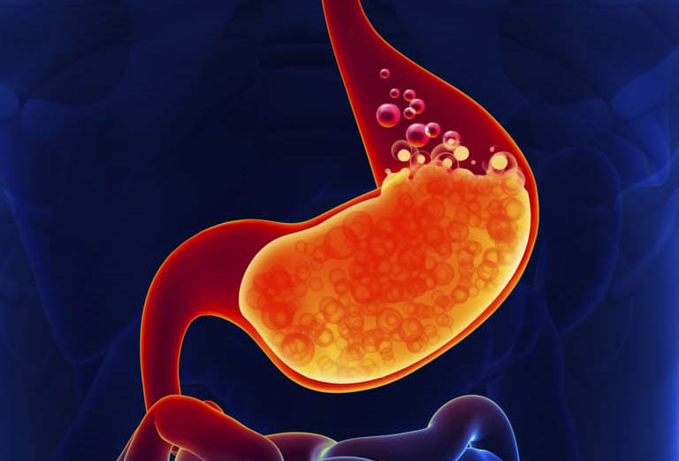 Tăng Axit Dạ Dày Vì Ăn Cay – Cách Giảm Nhanh