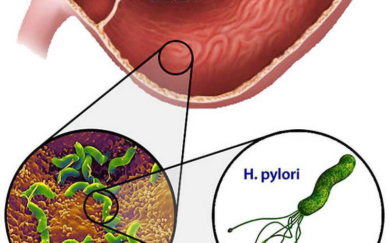 Dinh Dưỡng Hỗ Trợ Điều Trị Vi Khuẩn HP (Helicobacter Pylori)