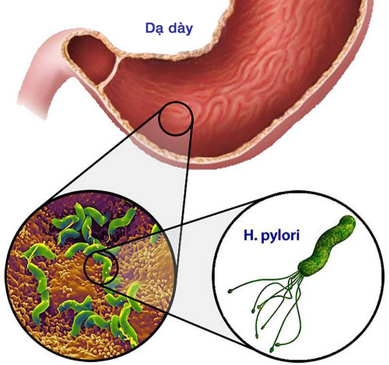 Dinh Dưỡng Hỗ Trợ Điều Trị Vi Khuẩn HP (Helicobacter Pylori)