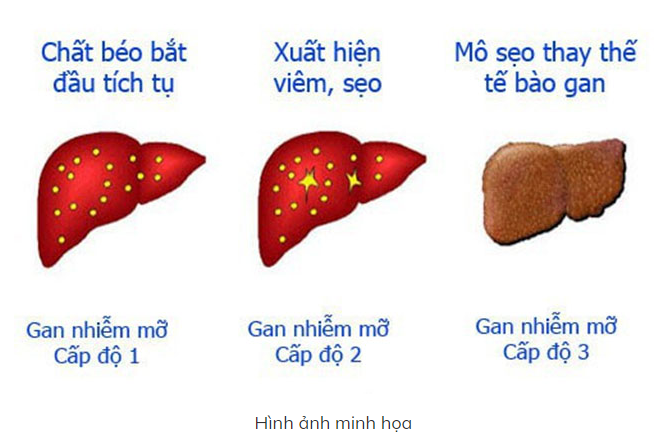 Gan Nhiễm Mỡ Độ 1: Dấu Hiệu Sớm Thường Bị Bỏ Qua
