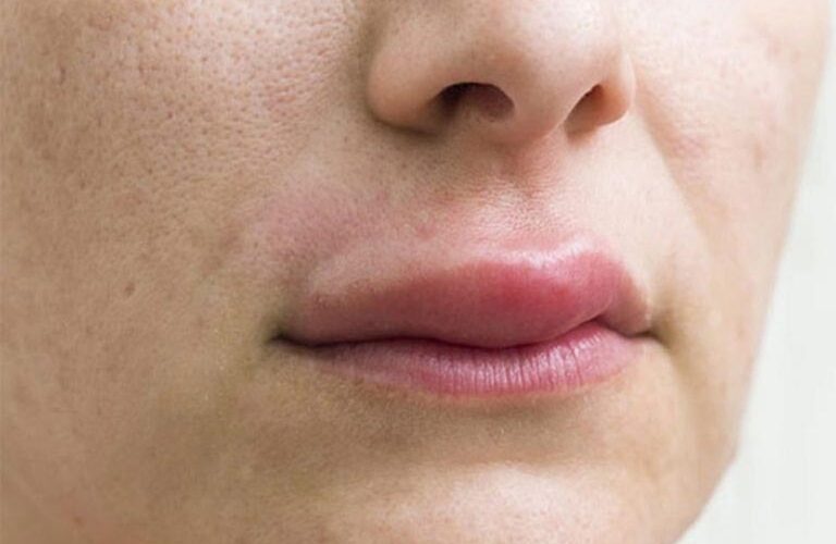 Sưng Môi Sau Khi Ăn – Cần Lưu Ý Gì?