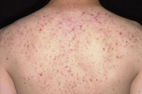 Xuất Hiện Mụn Lưng – Do Đâu?