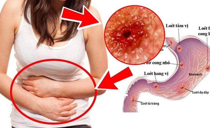 Cách Phòng Ngừa Viêm Loét Dạ Dày Hiệu Quả