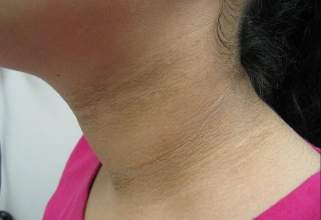 “Đánh Bại” Tình Trạng Kháng Insulin Bằng Thực Phẩm