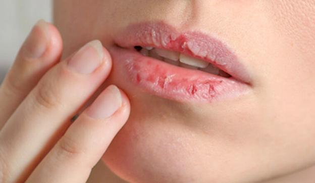 Môi Khô Nứt Nẻ? Có Thể Bạn Đang Thiếu Chất Này Đấy