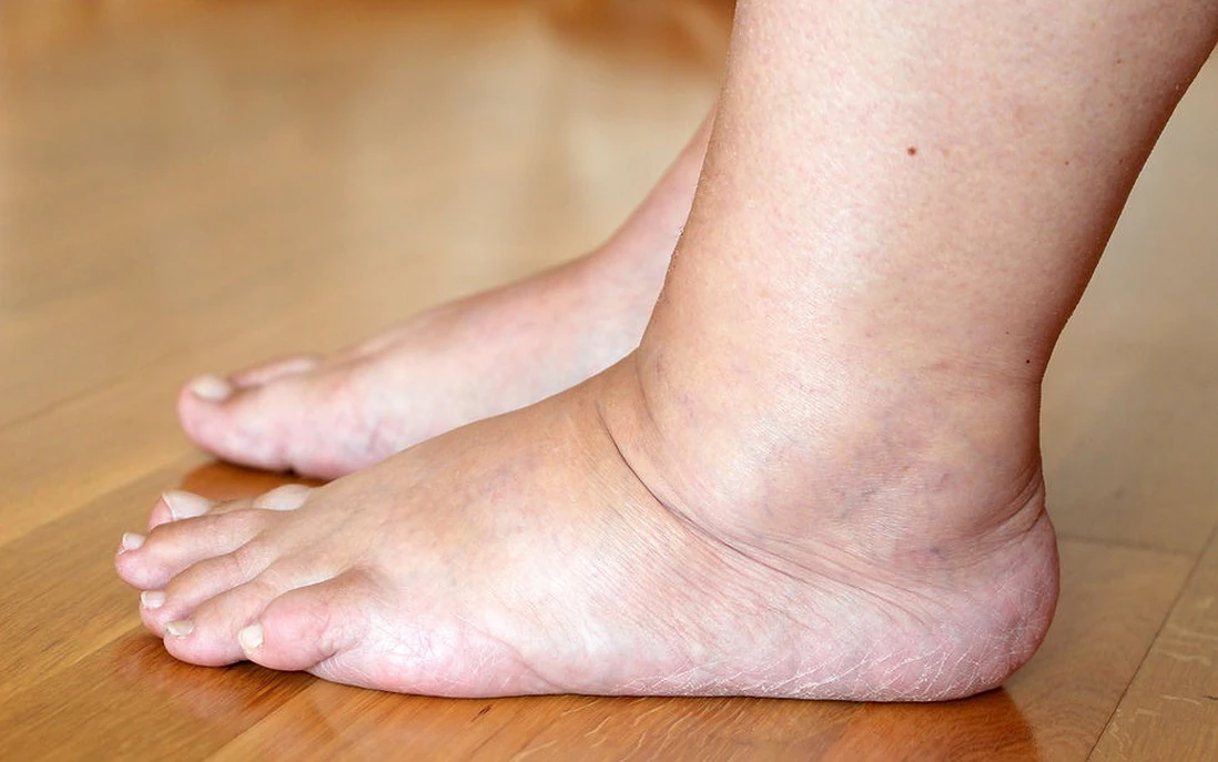 Công Thức Sinh Tố Giúp Giảm Tình Trạng Tích Nước, Sưng Phù