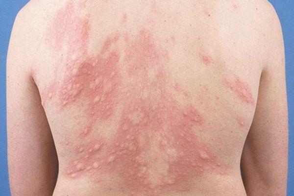 Dị Ứng Thức Ăn – Đừng Coi Thường Biểu Hiện Nhẹ