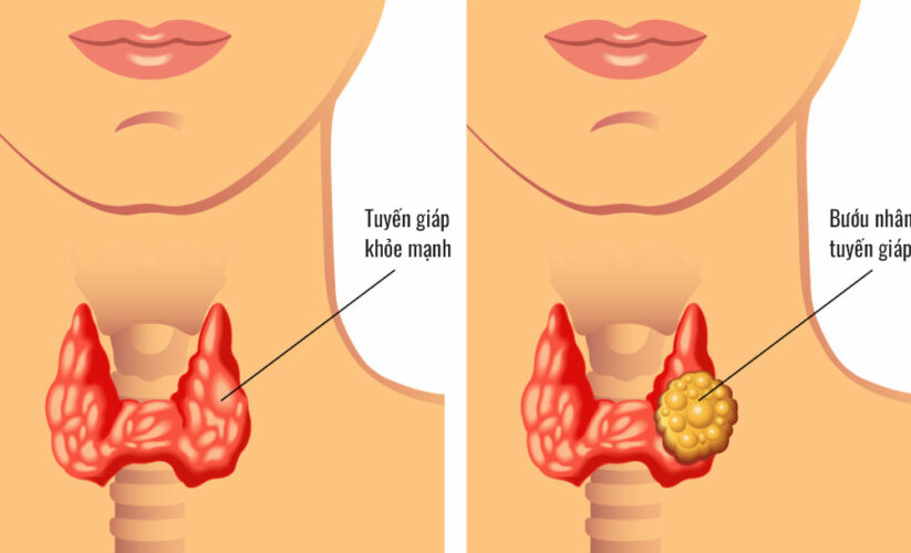 5 Thực Phẩm Nên Tránh Khi Bị Bệnh Tuyến Giáp Để Khỏe Hơn